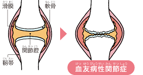 血友病性関節症の図